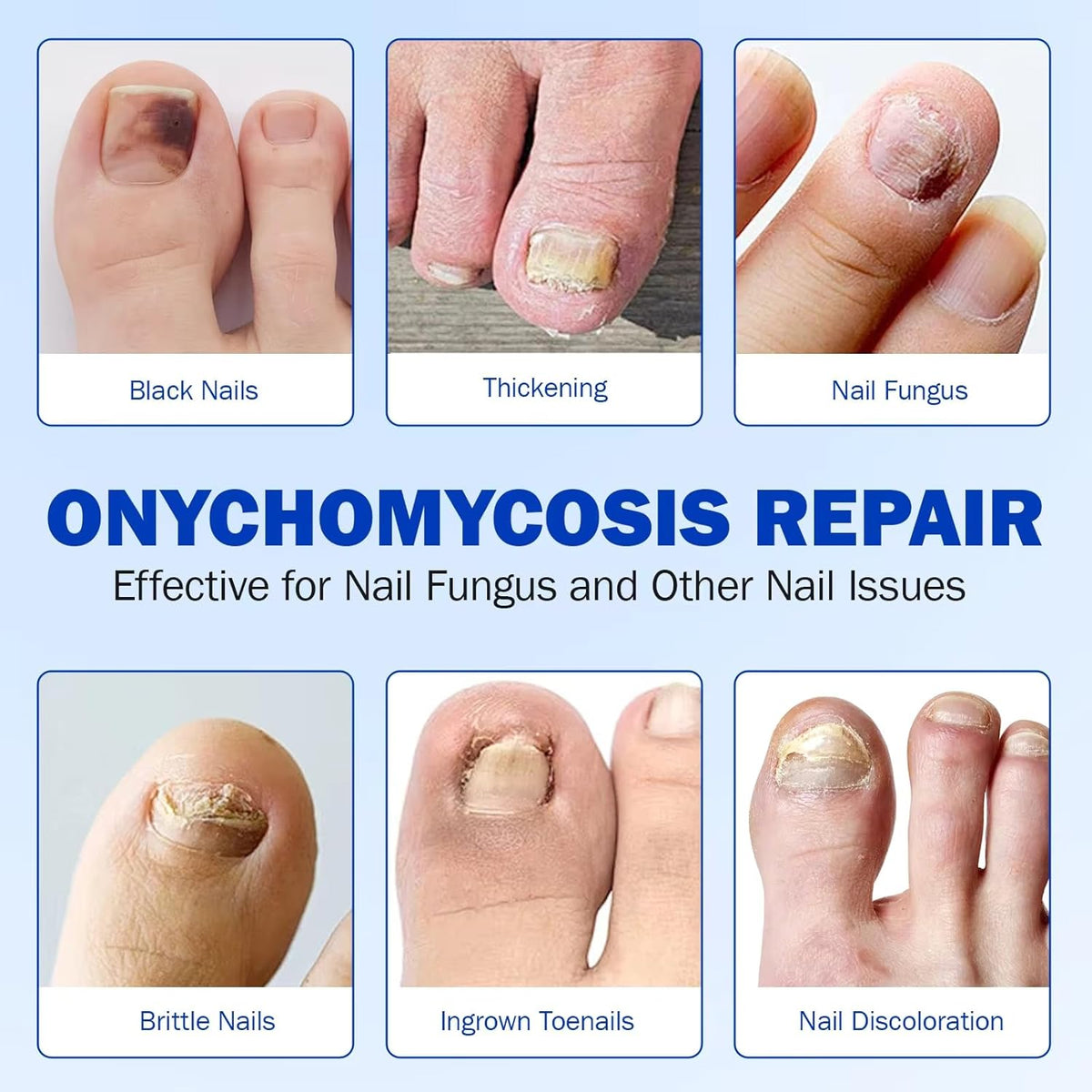 Nighttime Renewal Fungal Nail Treatment Patches