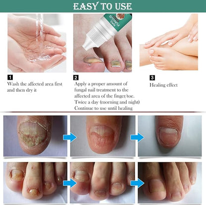 Nexusdrop Nail Fungus Solution